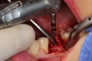 Bild 3 2 » Zahnarztpraxis Dr. Hahn Ferreira & ZÄ Radha - Saarbrücken Aufarbeitung des Implantatbett mit dem Bohrer in der Zahnarztpraxis Hahn Ferreira – Zahnarzt Saarbrücken