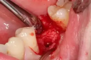 Bild 3 3 » Zahnarztpraxis Dr. Hahn Ferreira & ZÄ Radha - Saarbrücken Vorbereitung für das Einsetzen des Implantat-Körpers in der Zahnarztpraxis Hahn Ferreira – Zahnarzt Saarbrücken