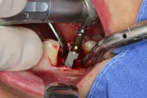 Bild 3 4 » Zahnarztpraxis Dr. Hahn Ferreira & ZÄ Radha - Saarbrücken Einsetzen des Implantat-Körpers in der Zahnarztpraxis Hahn Ferreira – Zahnarzt Saarbrücken