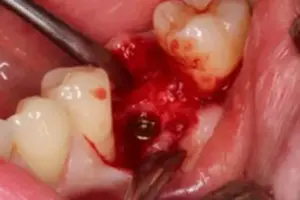 Bild 3 5 » Zahnarztpraxis Dr. Hahn Ferreira & ZÄ Radha - Saarbrücken Fertig eingesetzter Implantat-Körper in der Zahnarztpraxis Hahn Ferreira – Zahnarzt Saarbrücken