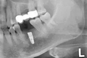 Bild 4 » Zahnarztpraxis Dr. Hahn Ferreira & ZÄ Radha - Saarbrücken Bild 4: Röntgenkontrolle der Implantatsposition nach erfolgtem Eingriff – Zahnimplantate Saarbrücken Dr. Hahn Ferreira