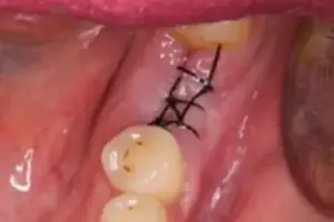 Bild 5 » Zahnarztpraxis Dr. Hahn Ferreira & ZÄ Radha - Saarbrücken Bild 5: frisch vernäht Zahnfleisch nach einsetzen des Implantat-Körpers in der Zahnarztpraxis Hahn Ferreira – Zahnarzt Saarbrücken