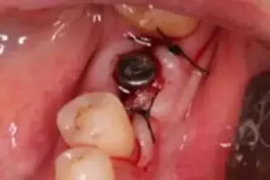 Bild 6 » Zahnarztpraxis Dr. Hahn Ferreira & ZÄ Radha - Saarbrücken Bild 6: Freilegung des Implantat-Körpers – Zahnimplantate Saarbrücken Dr. Hahn Ferreira