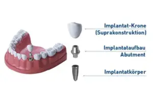 bild 1 aufbau implantat » Zahnarztpraxis Dr. Hahn Ferreira & ZÄ Radha - Saarbrücken Bild 1: Aufbau Implantat